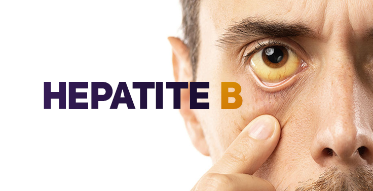 Imagem informativa de saúde com fundo branco. No lado esquerdo, sobressai o texto HEPATITE em letras roxas e a letra B em amarelo-ouro. No lado direito, vê-se em destaque o rosto de um homem puxando a pálpebra inferior do olho com o indicador, mostrando a esclera (parte branca do olho) amarelecida, sinal de icterícia.